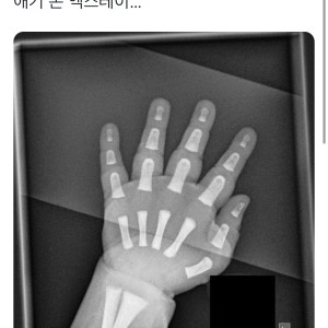 애기 손 엑스레이 | 인스티즈