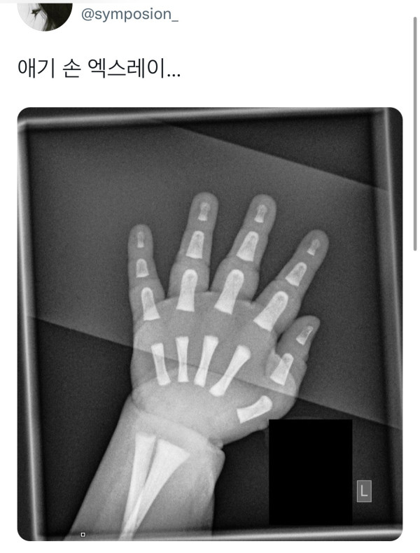 애기 손 엑스레이 | 인스티즈