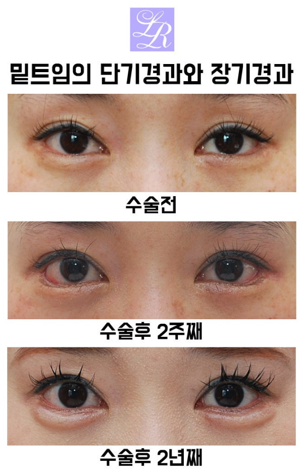 성형외과의사들도 말리는 뒷,밑트임 + 그럼에도 하는 이유 | 인스티즈